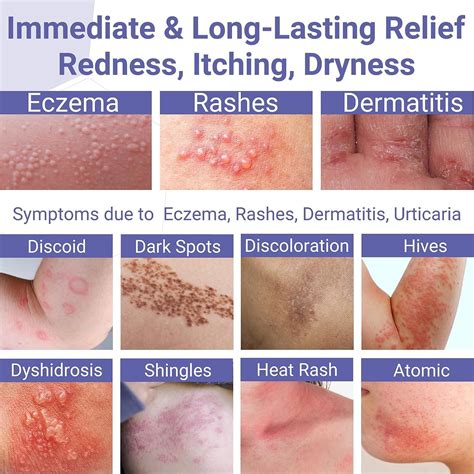 Eczema Rash Pictures