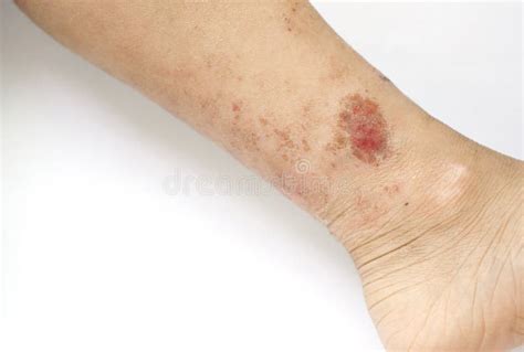 Eczema Rash Wound On Kid S Calf Stock Image Image Of Closeup Pain