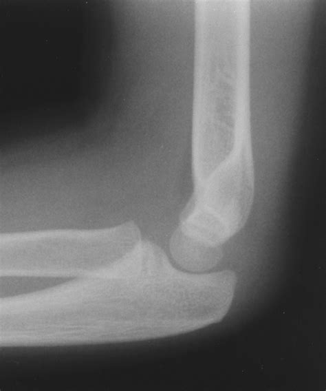 Elbow Effusions In Trauma In Adults And Children Is There An Occult