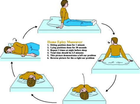 Epley Maneuver Guide PDF