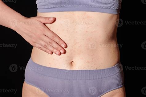 Erup O Al Rgica Vermelha Na Pele Da Barriga Dermatite At Pica Eczema