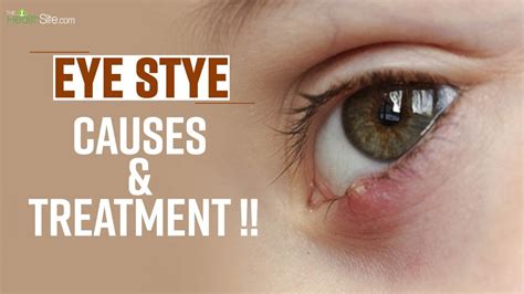 Eye Stye Causes Treatment Symptoms The Health Site Youtube