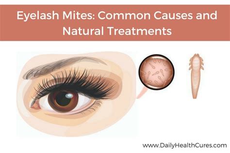 Eyelash Mites Causes Symptoms In Humans Pictures Mascara Eyebrow