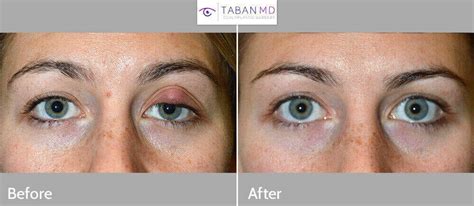Eyelid Chalazion Surgery Before And After Gallery Taban Md