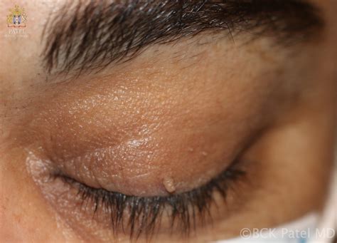 Eyelid Skin Tags: Causes And Treatment All About Vision, 51% Off