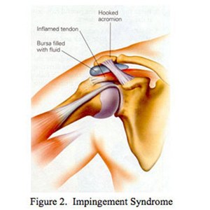 Femoroacetabular Impingement Syndrome Treatment Los Angeles