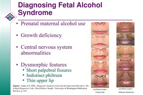 Fetal Alcohol Spectrum Disorder Jama The Jama Network