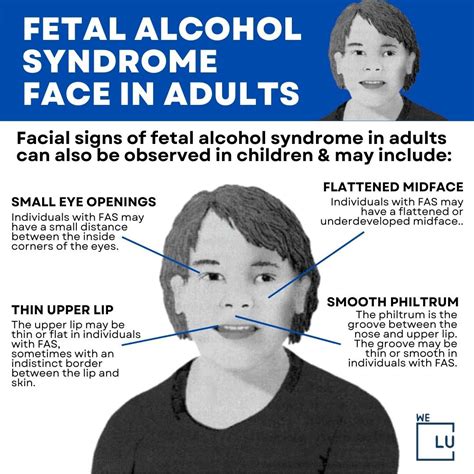 Fetal Alcohol Syndrome Fetal Alcohol Fetal Alcohol Syndrome Foetal
