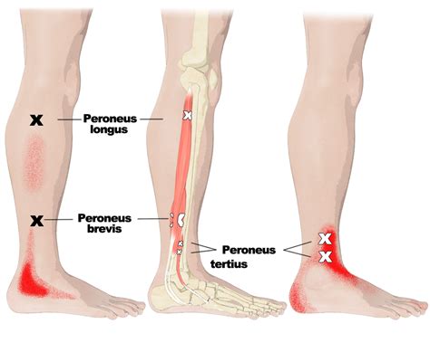 Fibularis Longus Pain