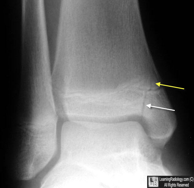 Figure 4 From Salter Harris Type Ii Fracture Of The Femoral Bone In A