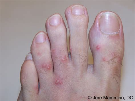 Fire Ant Bites American Osteopathic College Of Dermatology Aocd