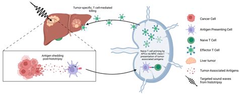 First Histotripsy Liver Tumor Treatment In Colorado At Presbyterian St