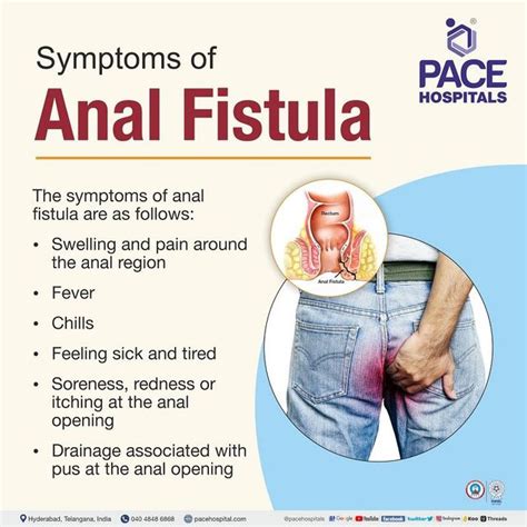 Fistula In Ano