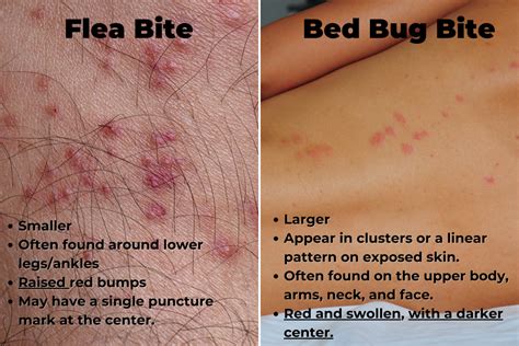 Flea Bite Pictures
