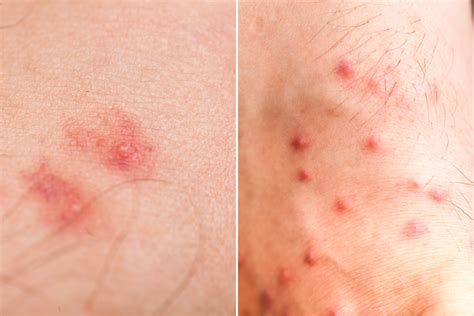 Flea Bites Humans Pictures