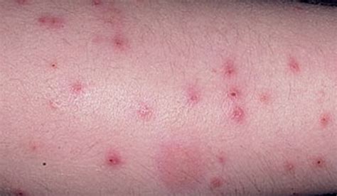 Flea Bites Pictures