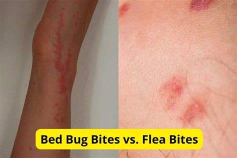 Flea Bites Vs Bed Bug