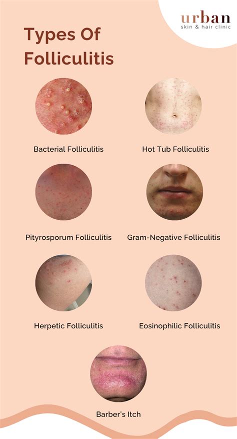 Folliculitis Symptoms Types And Treatments
