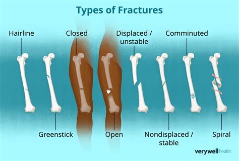 Fracture Vs Break