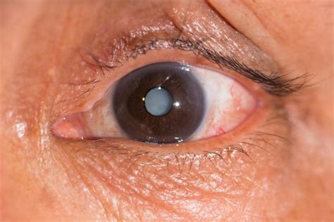 Genetics Study May Lead To Eye Drops For Cataracts Upi Com
