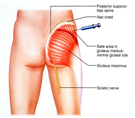 Glute Injection Site