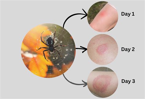 Grass Spider Bite Stages