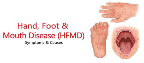 Hand Foot And Mouth Disease Hfmd Rash On Hands Hand Foot And