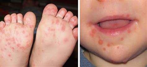 Hand Foot And Mouth Disease On The Rise Experts Beg Parents To Learn