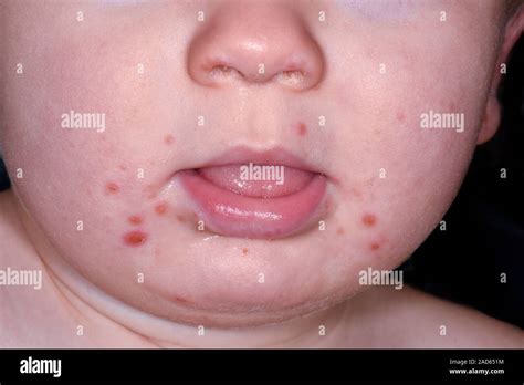 Hand Foot Mouth Disease Pictures