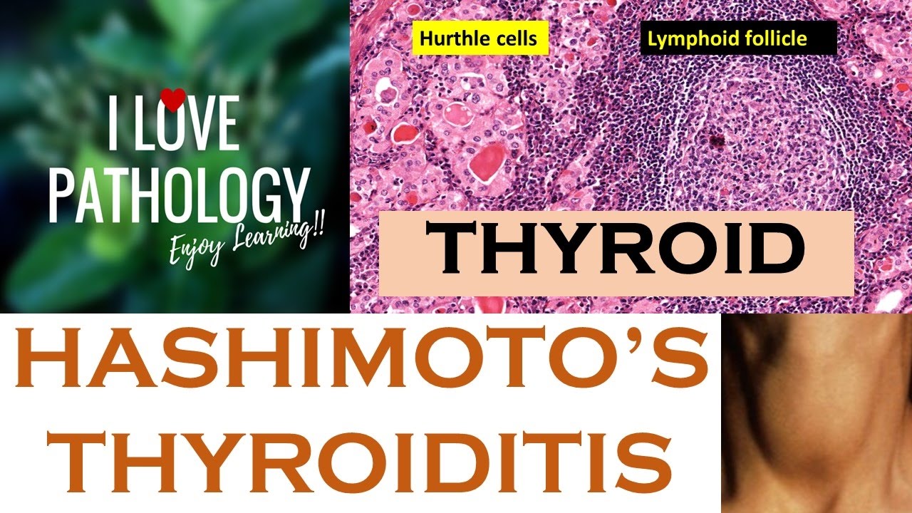 Hashimoto S Thyroiditis Symptoms Youtube