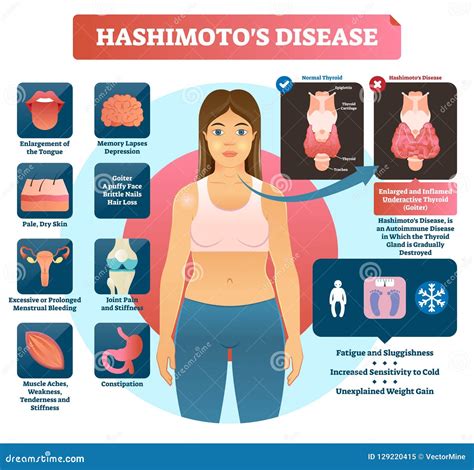 Hashimoto's Thyroiditis Rash
