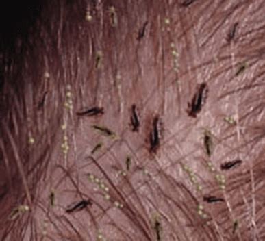 Head Lice Walk In Dermatology