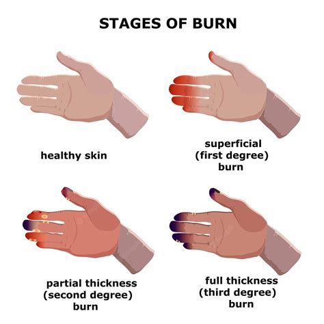Healing Stages Of 2Nd Degree Burns Explained