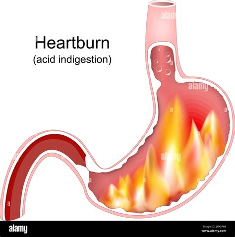 5 Tips Heartburn Spanish