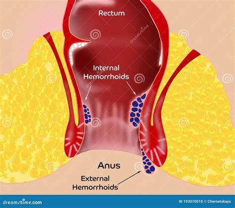 Hemorrhoid Illustration Of Unhealthy Lower Rectum With Inflamed