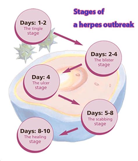 Herpes Outbreak Timeline