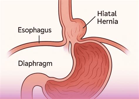 Hiatal Hernia Treatment In Nj Bergen Medical Associates