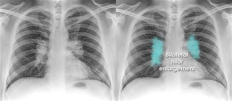 Hilum In Lung Cancer Cxr