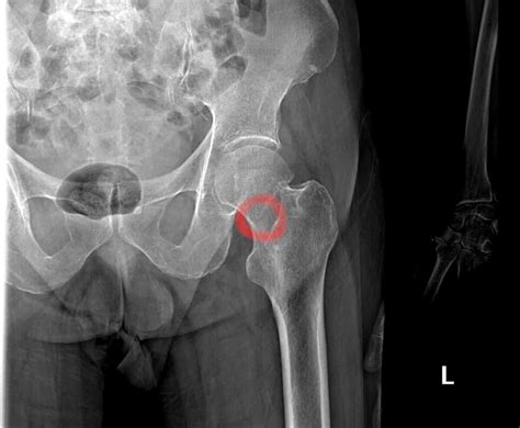 Hip Stress Fracture