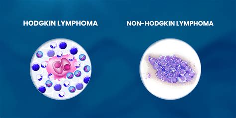 Hodgkin Vs Non Hodgkin Lymphoma Differences Between Hodgkin And Non