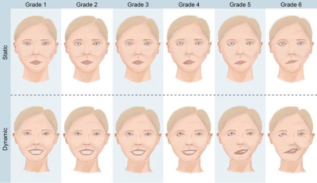 House Brackmann Facial Nerve Grading System Download Scientific Diagram