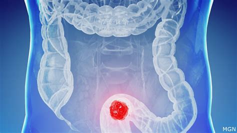 How Colorectal Cancer Develops And Some Healthy Lifestyle Habits To