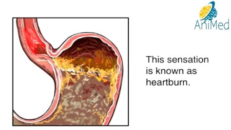 How Heartburn Works Animation Acid Reflux Disease Symptoms Causes