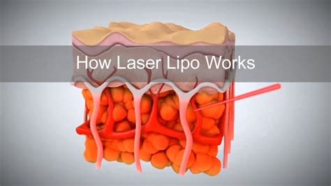 How Laser Lipo Works To Release Fat And Reduce Cellulite Youtube