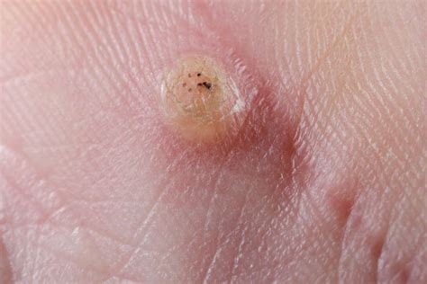 How To Easily Get Rid Of Warts On Hands Overnight 2023 Update