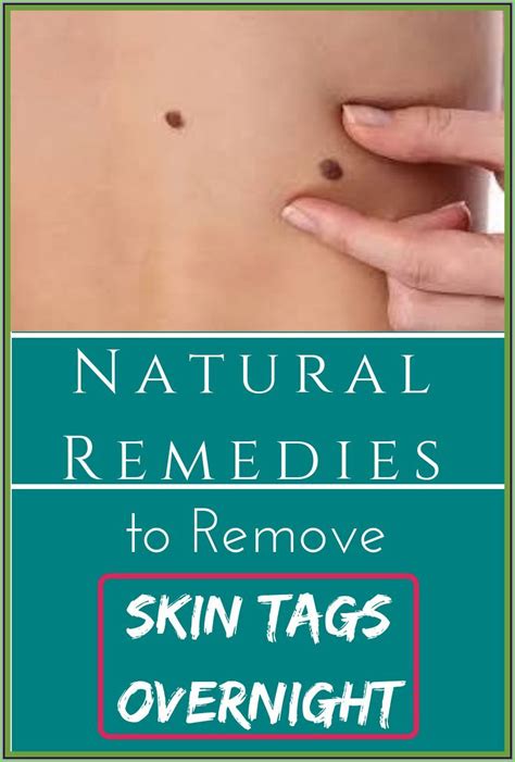How To Remove Skin Tag Overnight