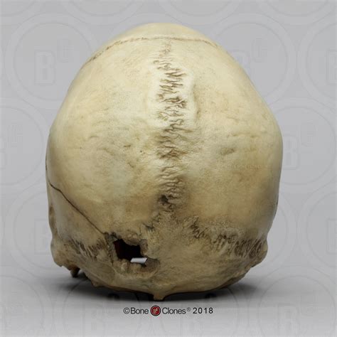Human Male Skull With A 32 Caliber Gunshot Wound Bone Clones Inc