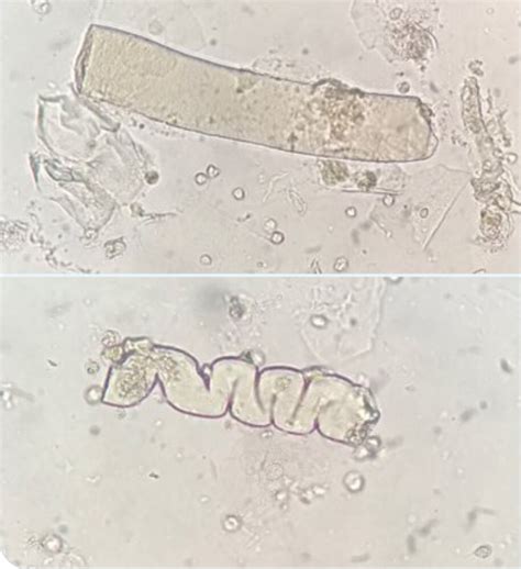 Hyaline Cast In Urine Specimen Youtube