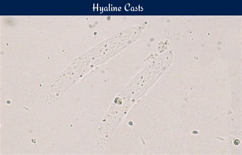 Hyaline Casts in Urine Meaning