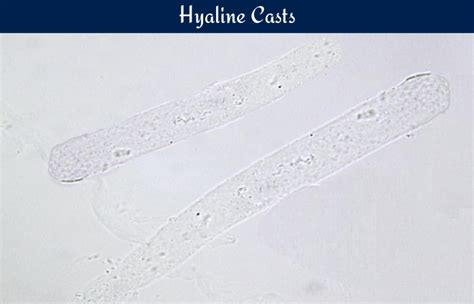 Hyaline Casts Urinalysis